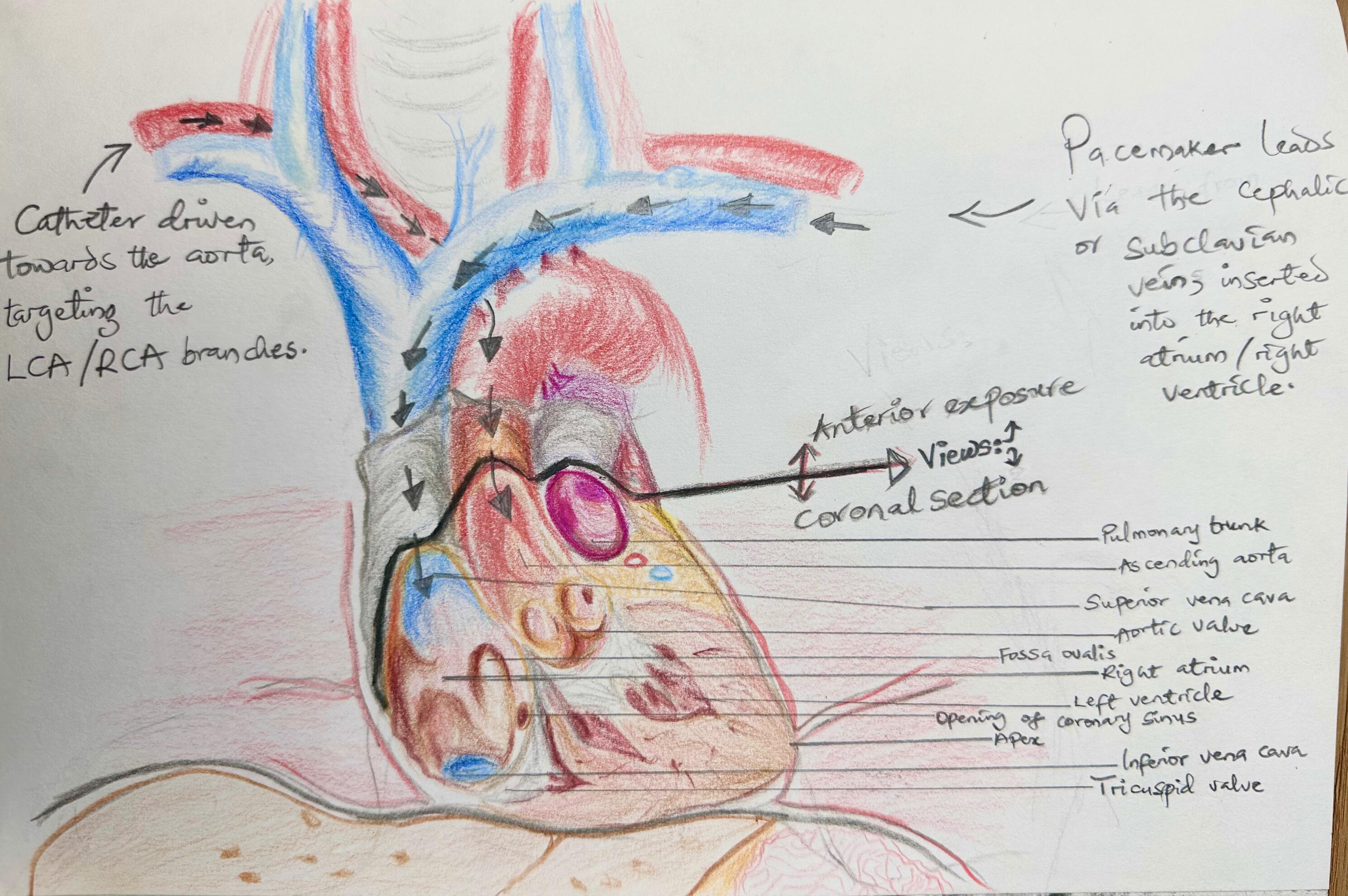 Anterior + Coronal View of the Heart for Angio &amp; Pacing | 2025: A visual on the different pathways between procedures for a pacemaker insertion Vs an angiography/angioplasty/stenting.