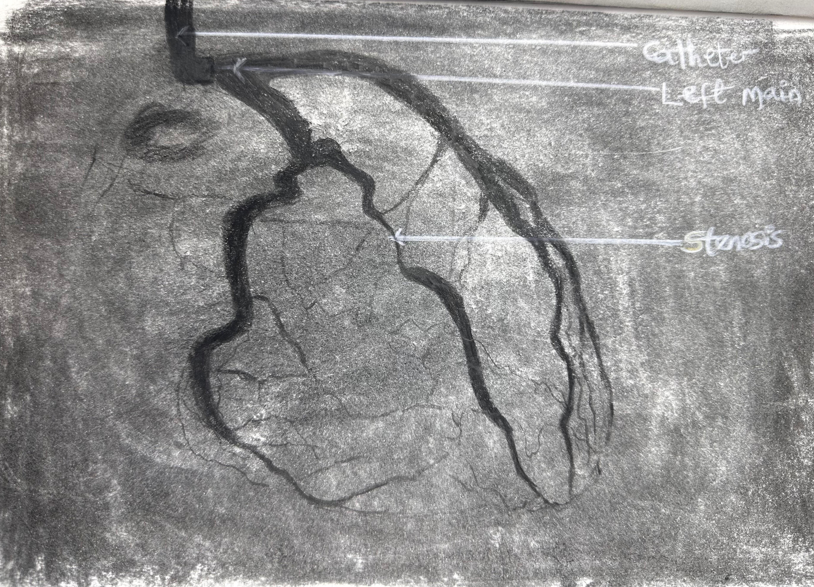 Left Main Stem and Branches During a Cardiac Angiogram, Showing Stenosis | Charcoal + Graphite Pencil on Paper | 2025