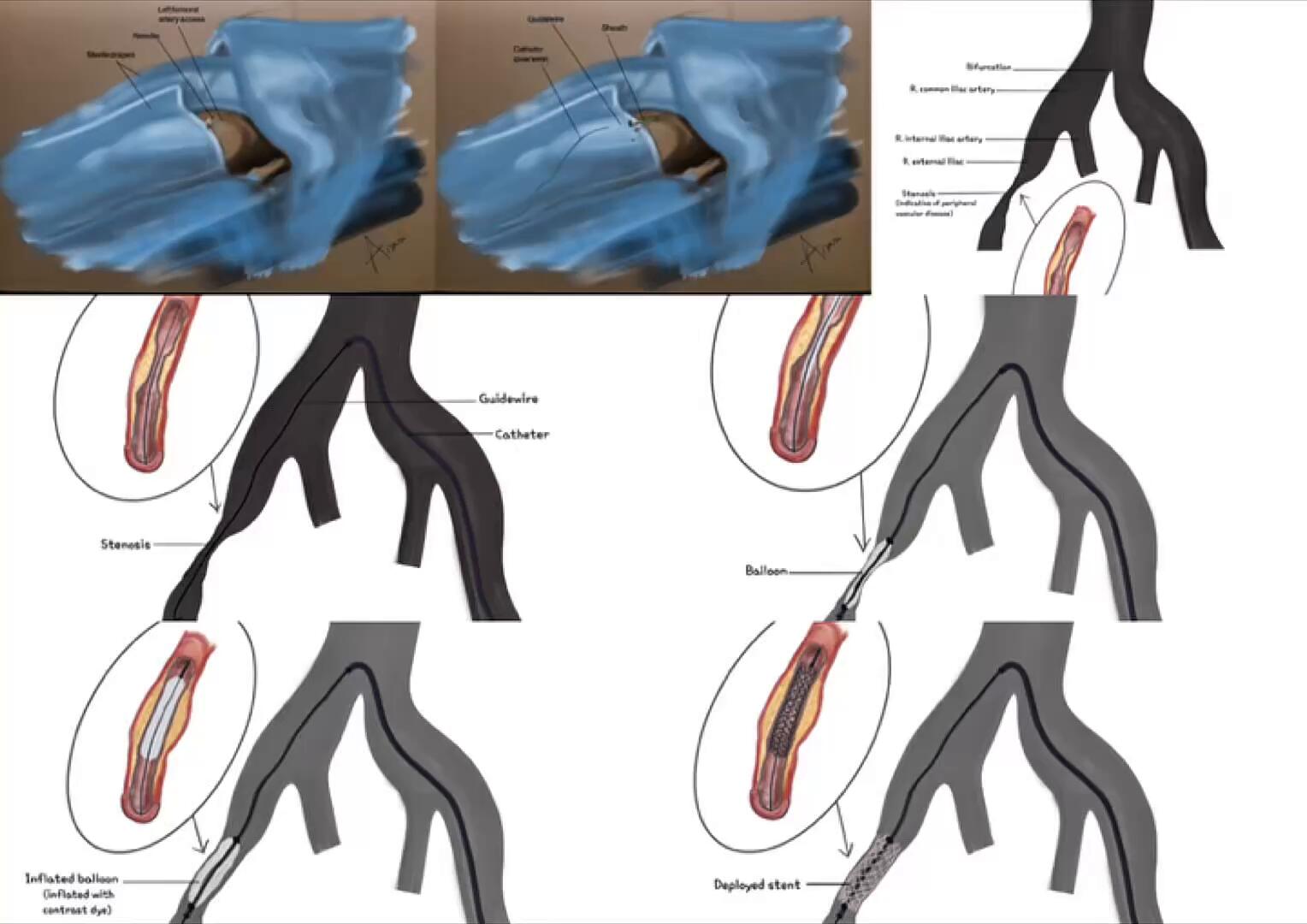 **Angioplasty & Stenting: An Illustrated Sequence for the Interventional Treatment of Peripheral Vascular Disease** | Digital |