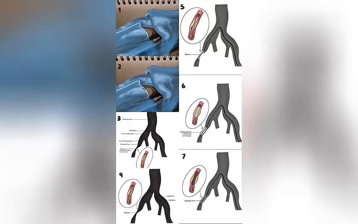 Angioplasty & Stenting: An Illustrated Sequence for the Interventional Treatment of Peripheral Vascular Disease | Digital | 2025